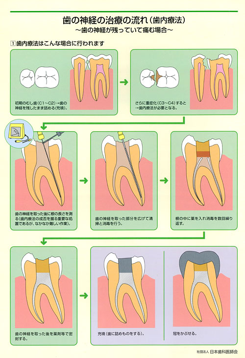 歯の神経の治療の流れ