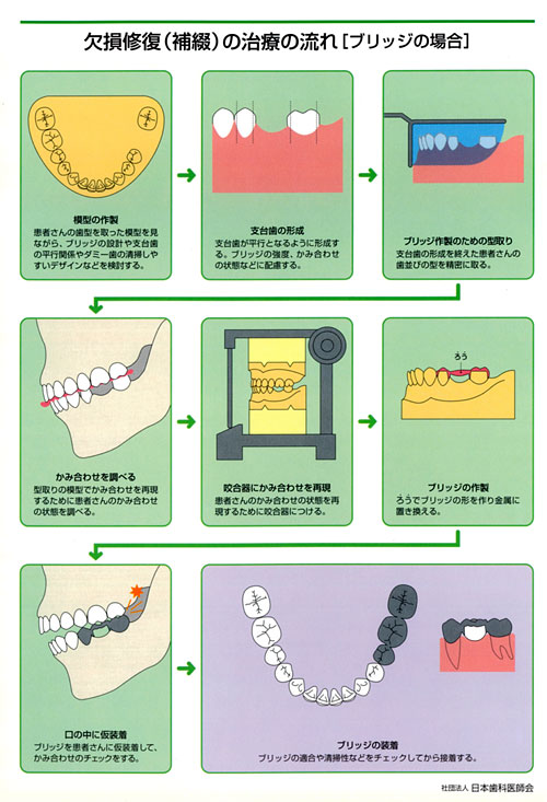 補綴（修復）治療の流れ　ブリッジの場合