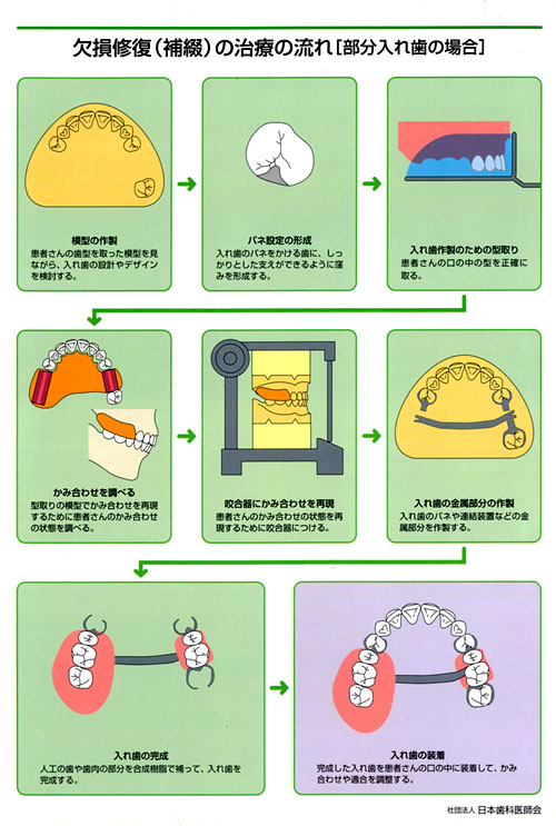 補綴（修復）治療の流れ　部分入れ歯の場合