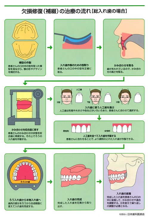 補綴(修復)治療の流れ 総入れ歯の場合