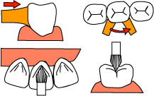 頬舌面・咬合面の清掃･研磨